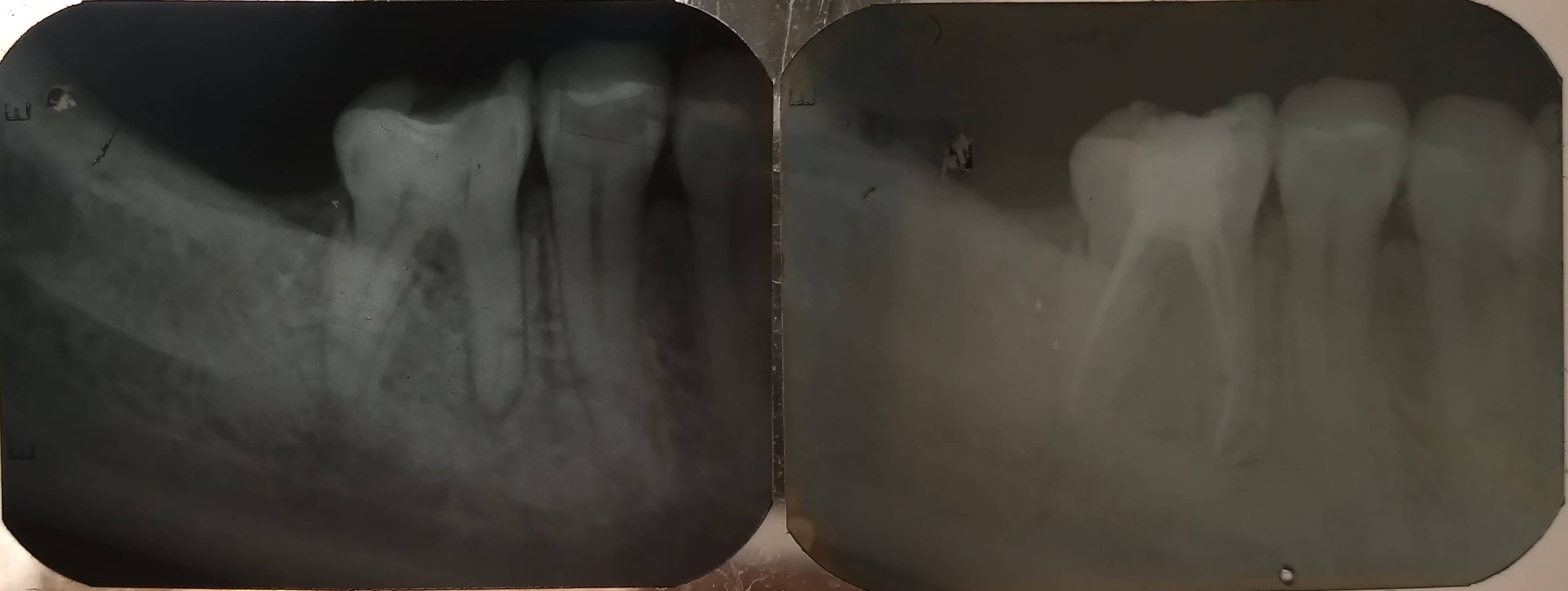 Endodoncia
